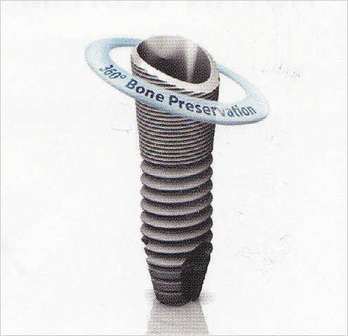 アストラテックインプラントのオッセオスピードTXって凄い