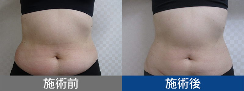 最新の脂肪冷却痩身ならクラツーアルファ！部分痩せを目指し、切らずに