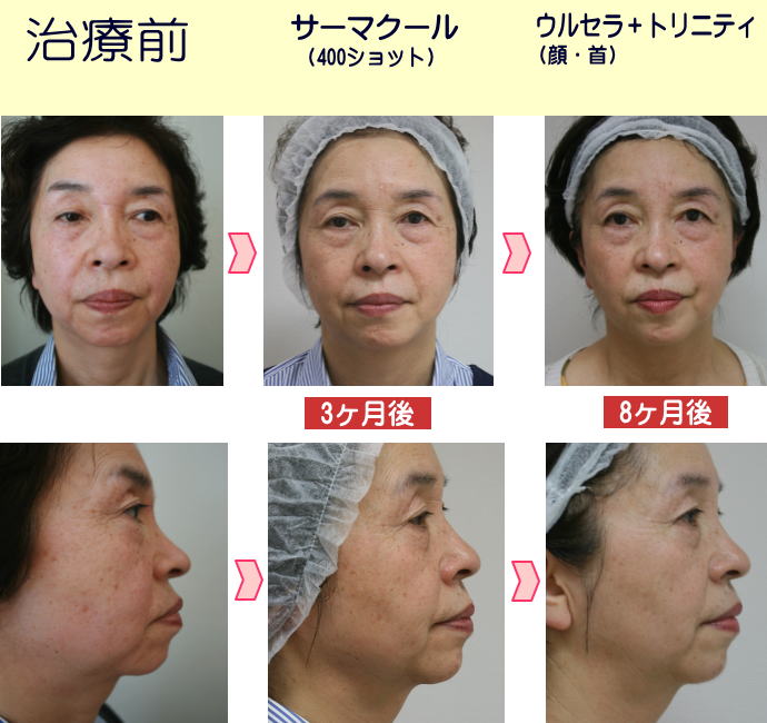 サーマクールは施術でこんなに違う効果-かえって老けないために