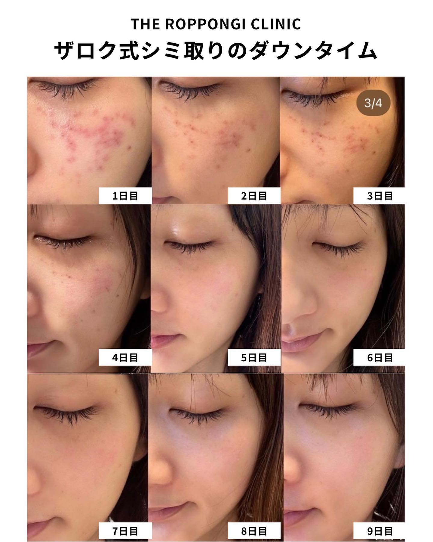 テープ不要のシミ取り】ピコレーザーのダウンタイム大公開 のビフォー