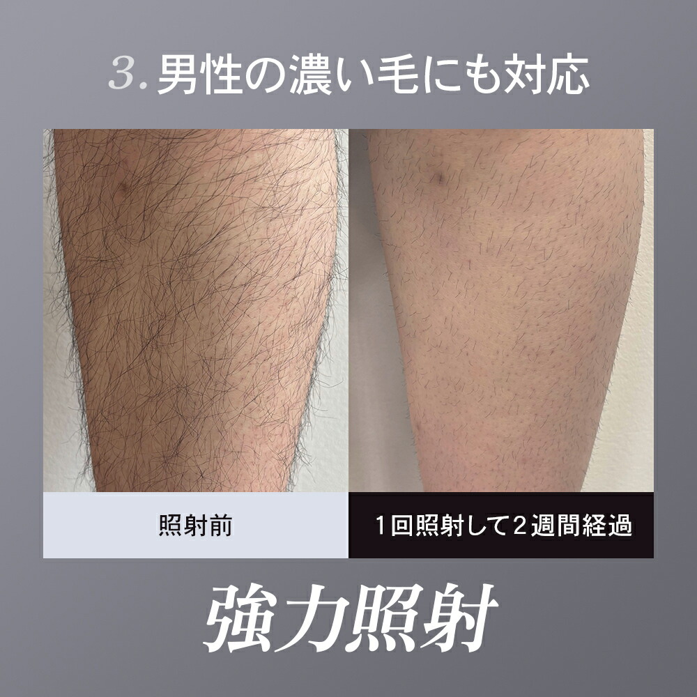 楽天市場】ium イウム スピードショット SPEED SHOT 光美容器 ムダ毛