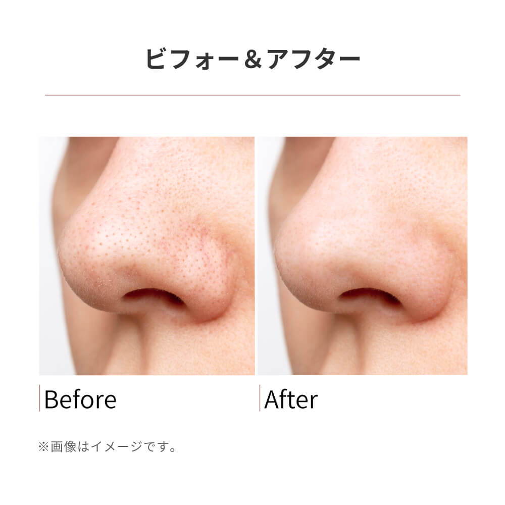 楽天市場】Areti アレティ 毛穴吸引器 スマホ連動 吸引式 スキンケア