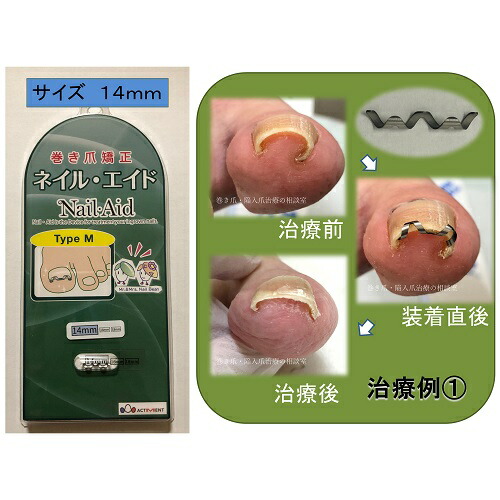 楽天市場】巻き爪 自分で 巻き爪矯正 【 ネイル・エイド 14mm