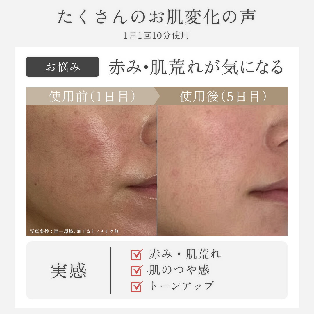 楽天市場】【10％OFF＆PT20倍！】可変式RF×可変式EMS×3色LED 美顔器