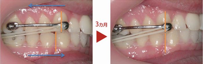 カリエールディスタライザー｜アクイユ矯正歯科クリニック（所沢市