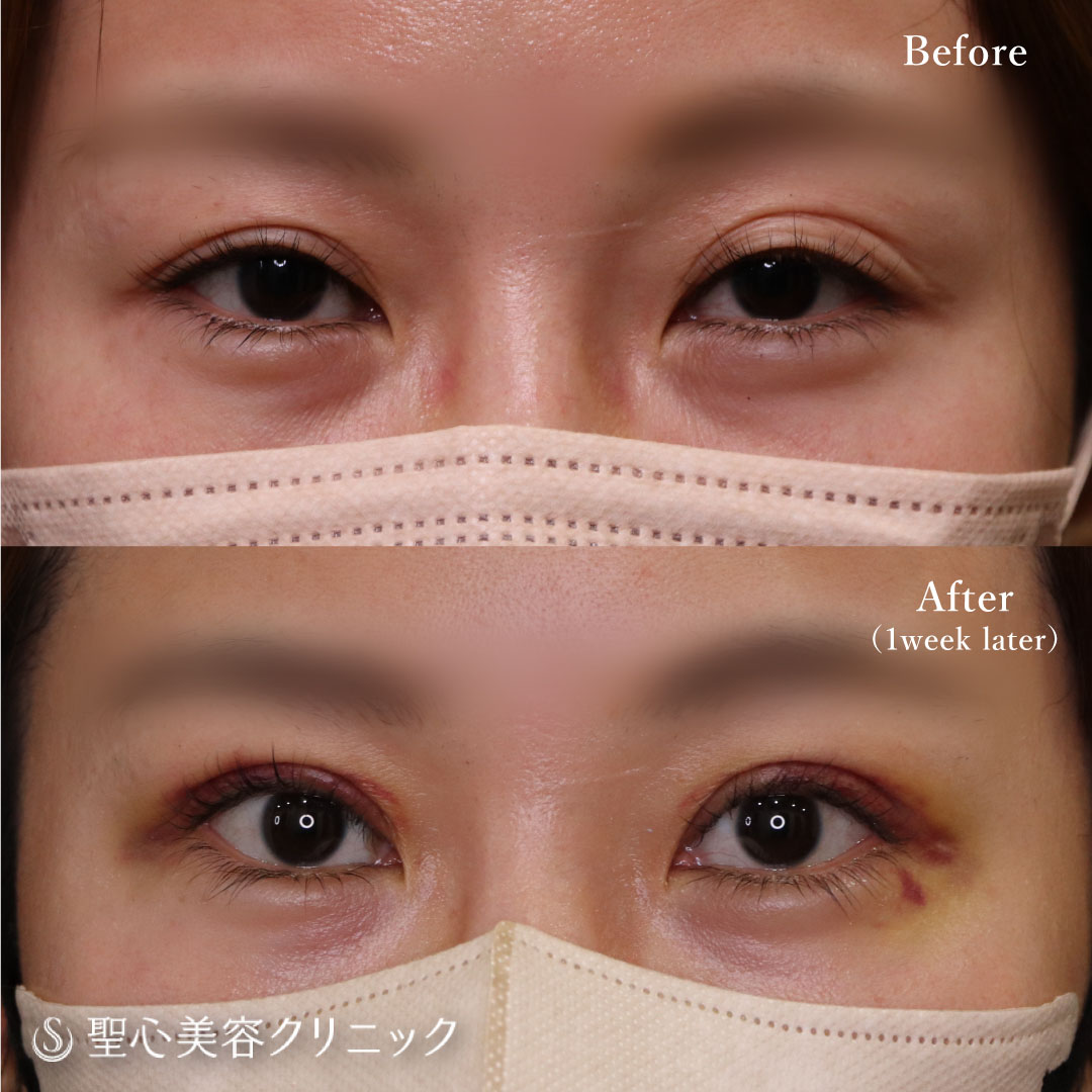 顔全体のアンチエイジング | ・目のクマ・くぼみ・たるみの症例写真