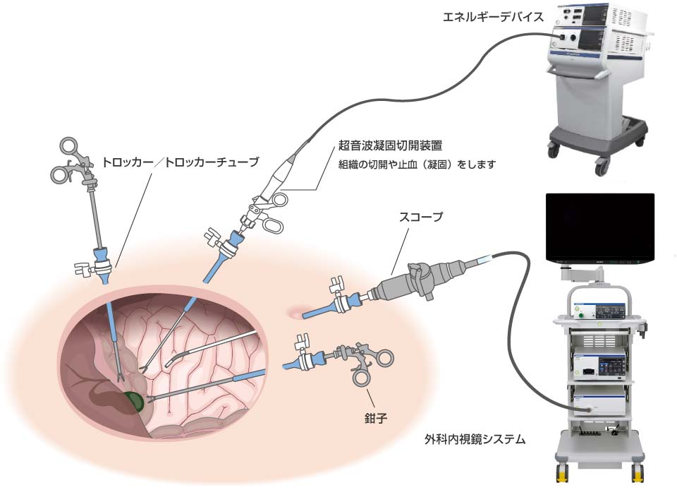 医療事業概要：医療製品：オリンパス