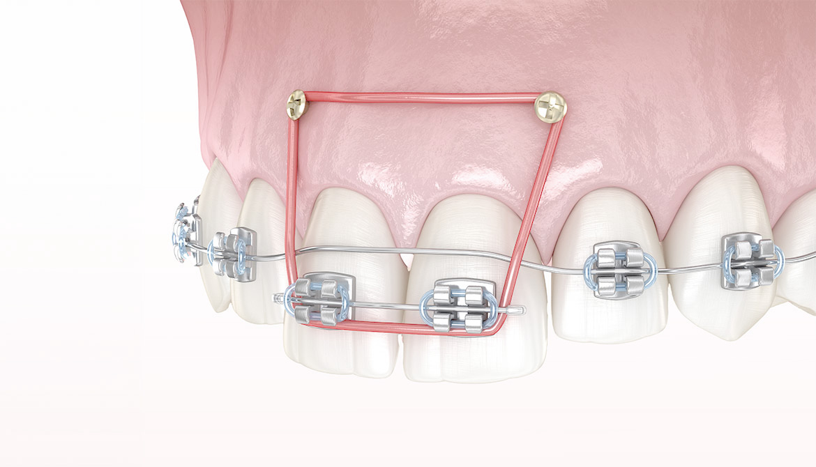 仙台の矯正│仙台東口矯正歯科