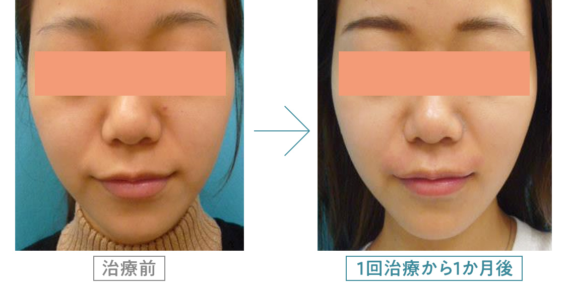 サーマクール | 大阪でサーマクールを施すなら「つかはらクリニック」