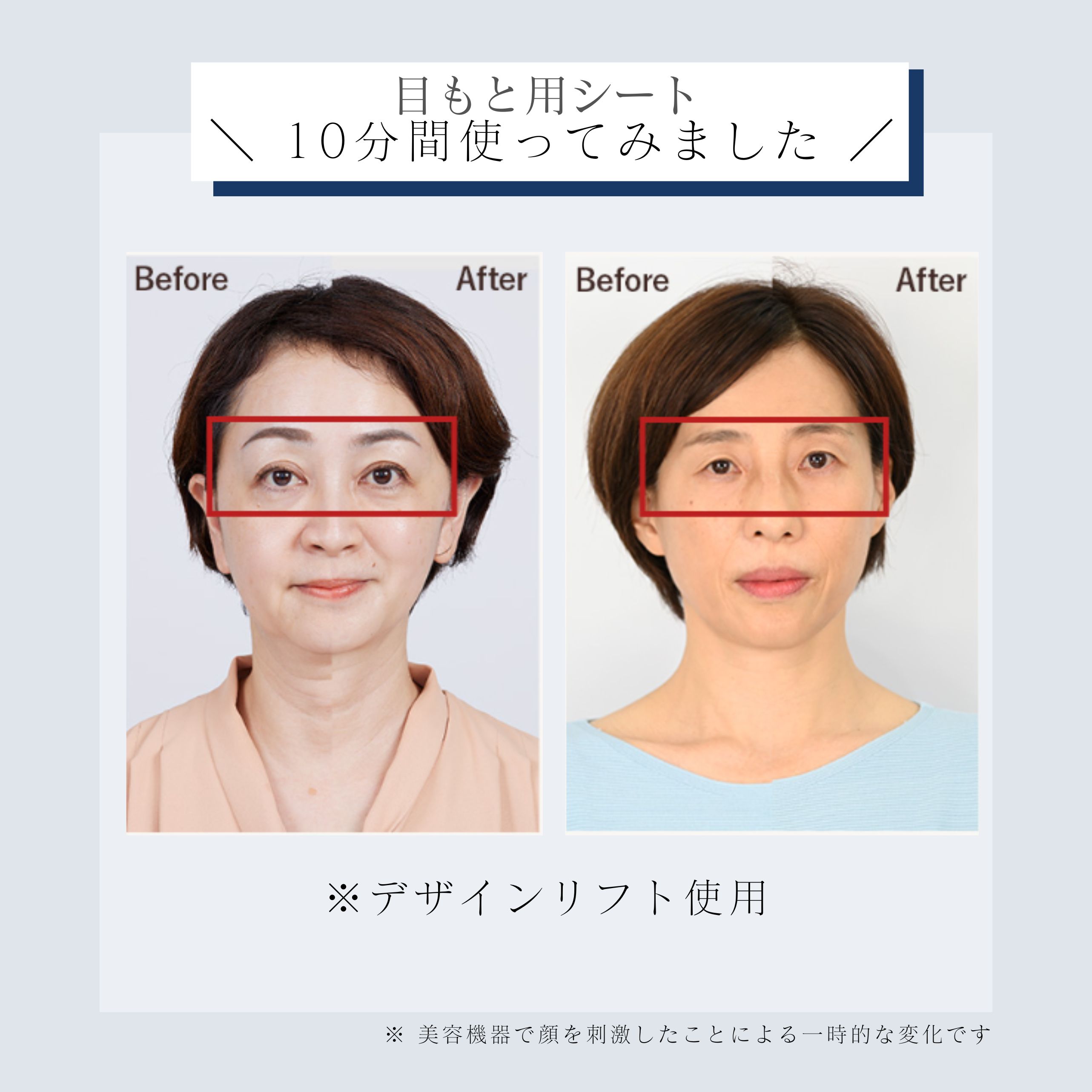 デザインリフトモア口もと集中4か月コース（C1）｜ヤーマン公式通販