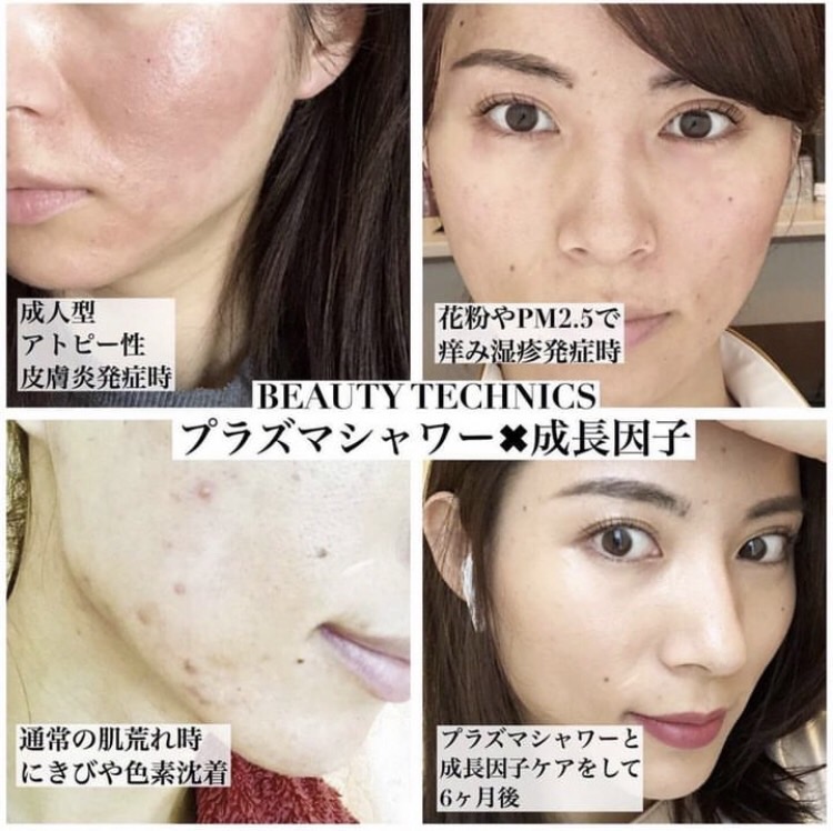 お家でプラズマフェイシャル！？育毛、発毛、白髪改善も！？『プラズマ