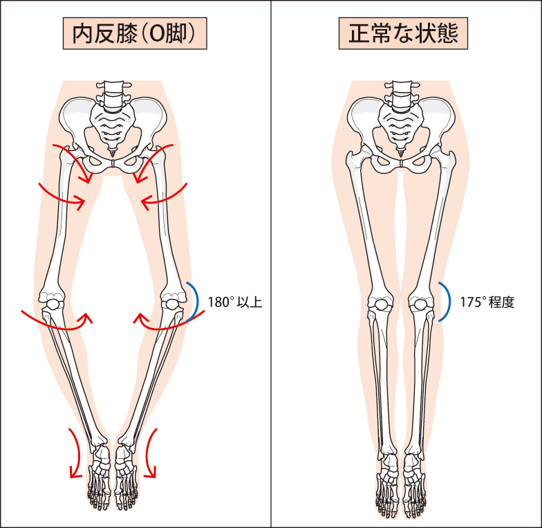 変形性膝関節症｜保土ヶ谷区の整形外科・内科｜横山医院｜リハビリ