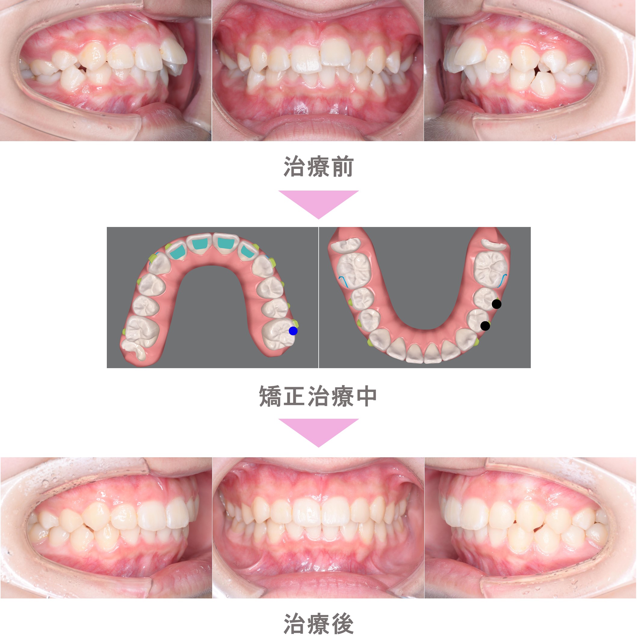 インビザライン矯正（マウスピース矯正）の症例紹介｜出っ歯（上顎前突