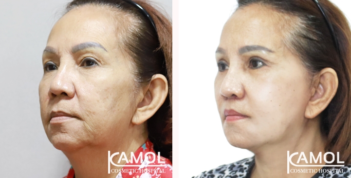 フェイスリフト / ネックリフト - Kamol Hospital