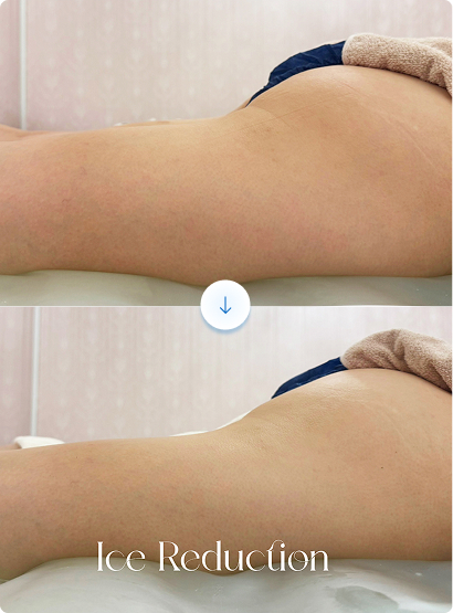 アイスリダクション