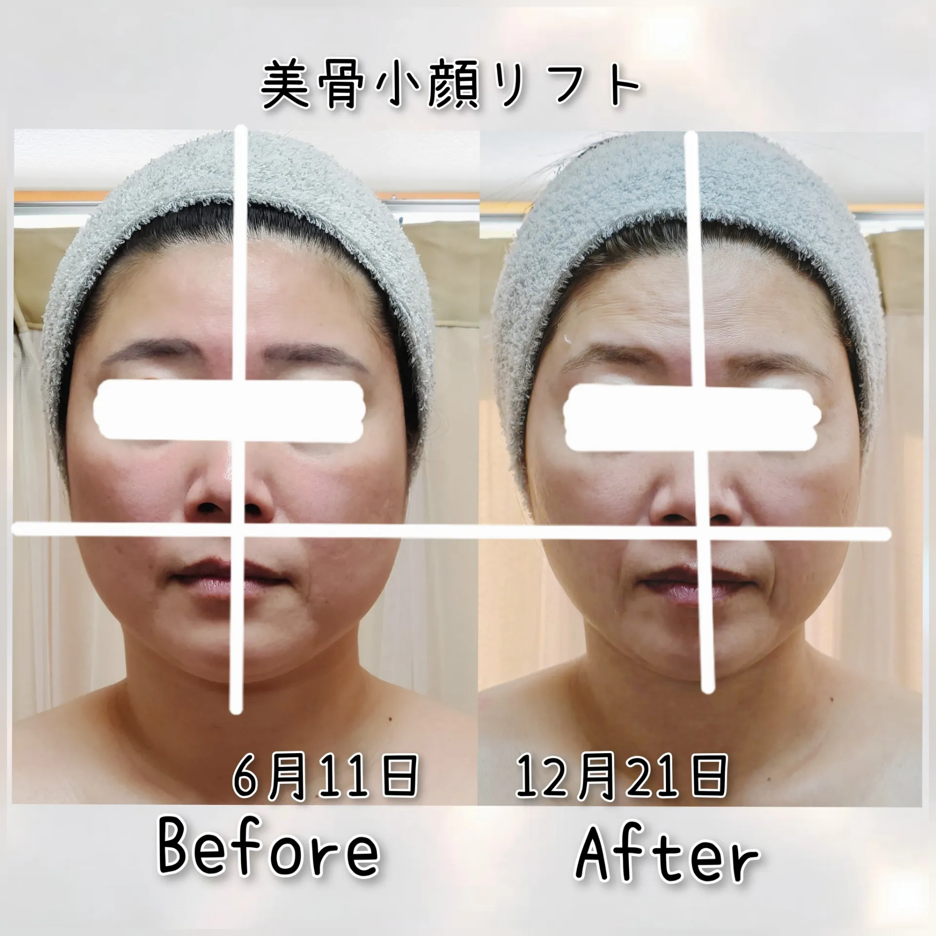 美骨小顔リフト【茨城県古河市エステサロン】 | ブログ | 古河市の