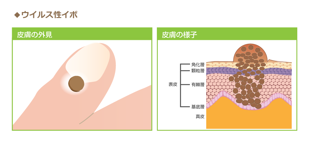 イボ（尋常性疣贅:ゆうぜい） - 銀座まいにちクリニック 内科・皮膚科