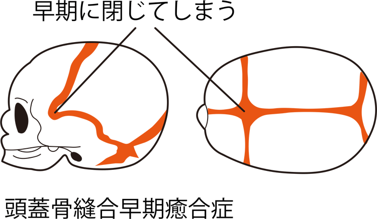 頭蓋骨縫合早期癒合症 | 病気と治療の検索サイト「メディカルブレイン」