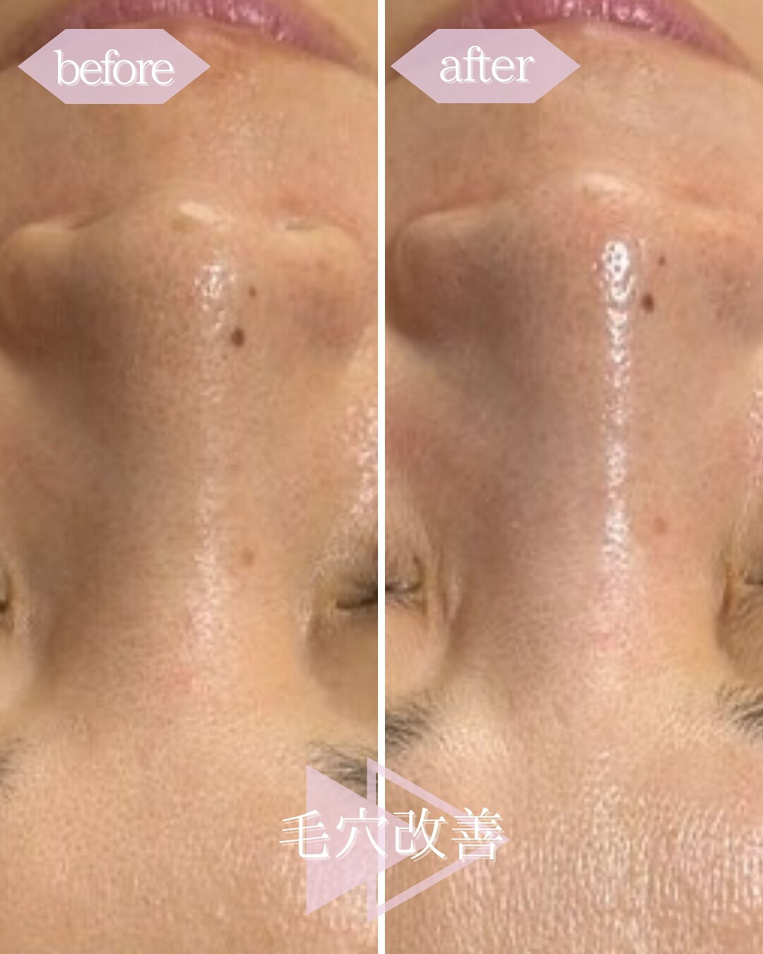 ハーブピーリングで毛穴改善👃】 | ブログ | 東京都東銀座築地のエステ