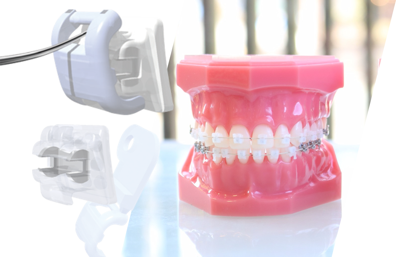 フルパッシブ矯正 - 武蔵小杉ネゴ歯科矯正歯科｜武蔵小杉の歯医者なら