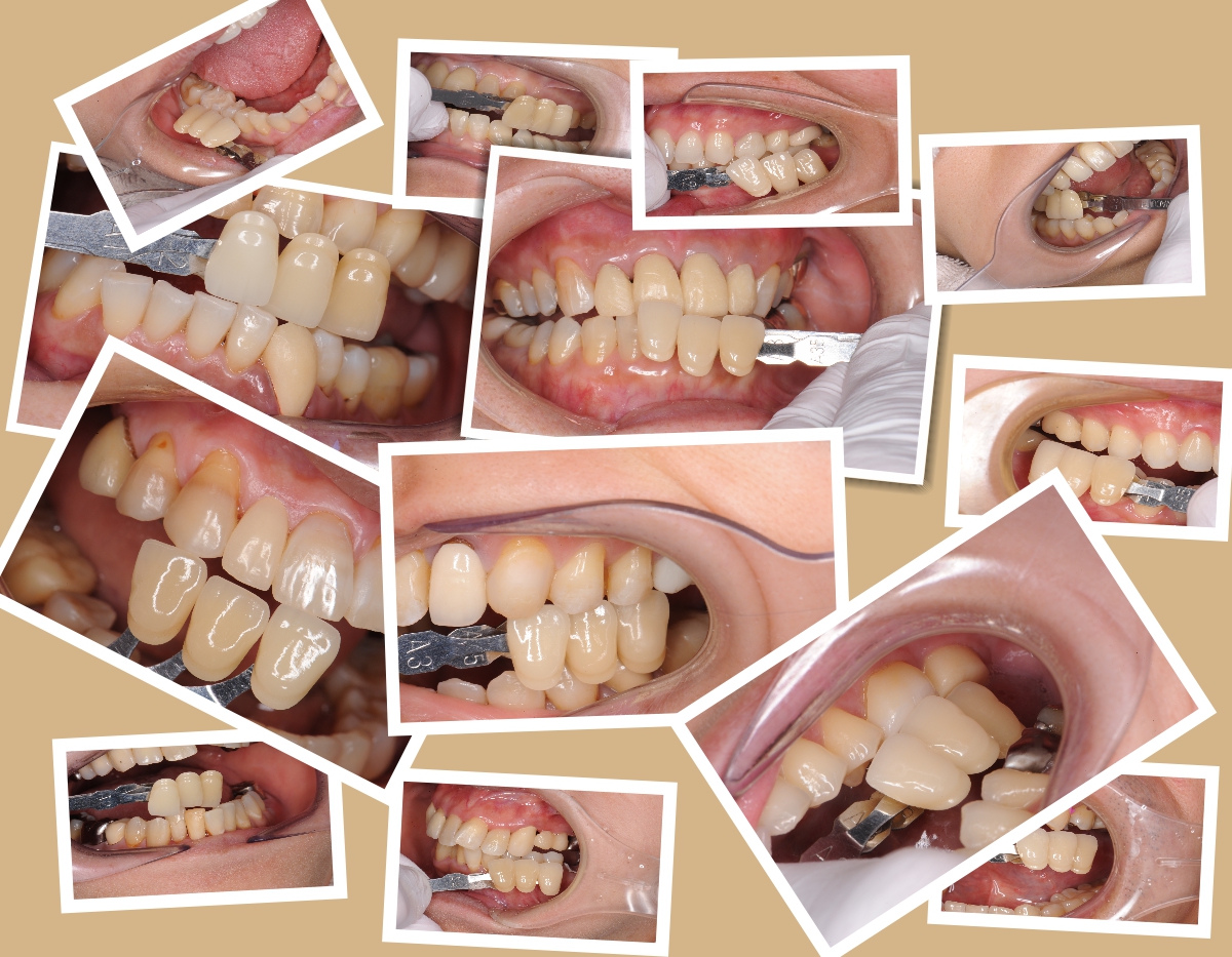 セラミックの色を決める際に大切な事 | 世田谷区豪徳寺 西原デンタル